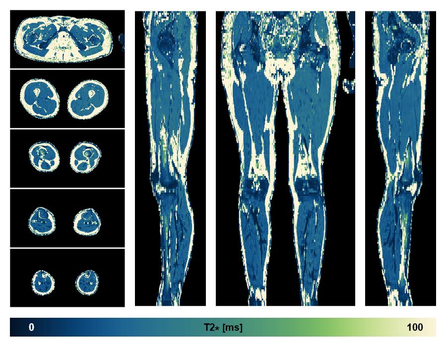 The T2 star relaxation time of the lower extremity obtained from the dixon reconstruction for muscle water fat quantification.